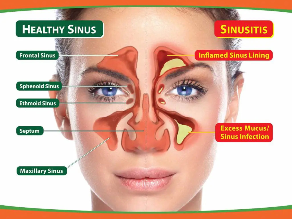 Difference between a healthy Sinus and a congested sinus